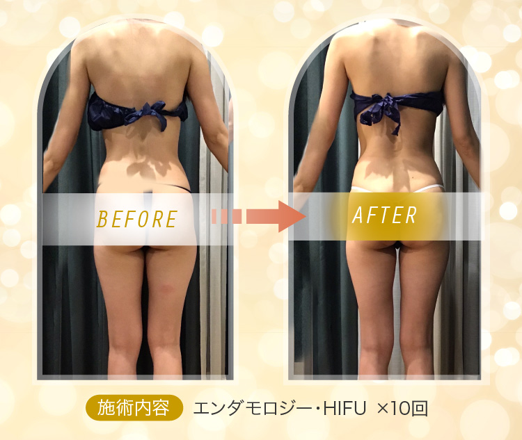 Before&After 施術内容：エンダモロジー・HIFU ×10回