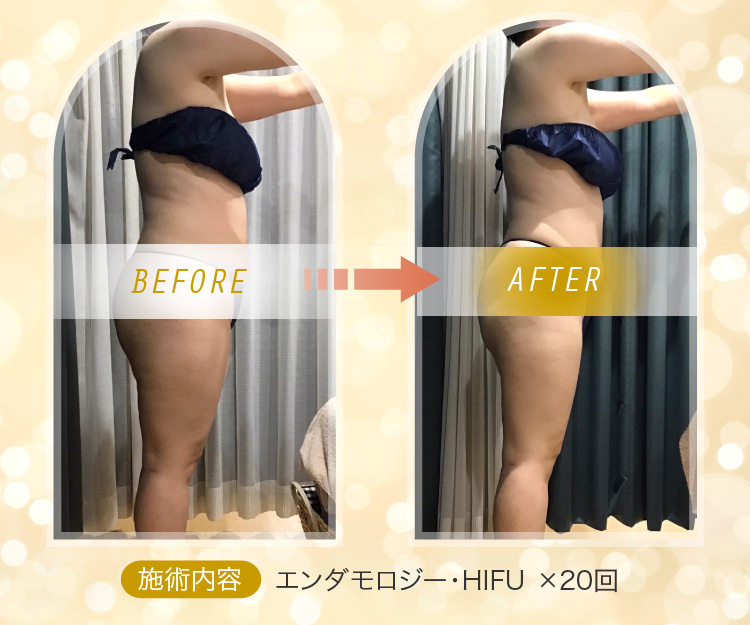 Before&After 施術内容：エンダモロジー・HIFU ×20回