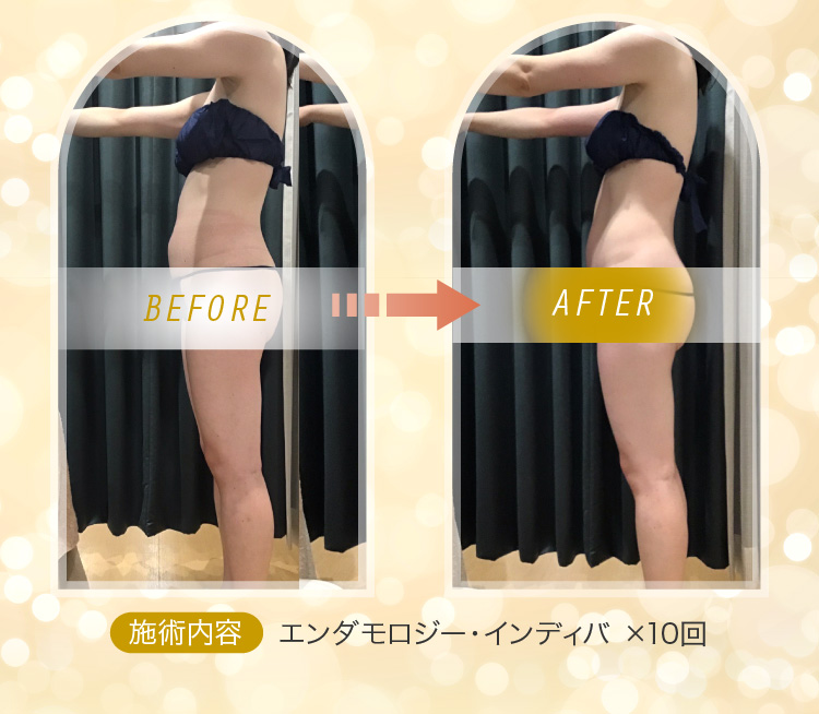 Before&After 施術内容：エンダモロジー・インディバ ×10回